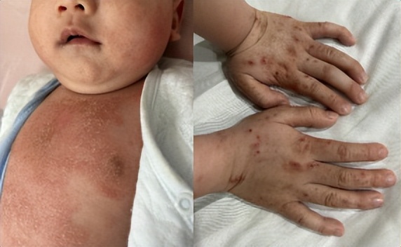2周半宝宝有湿疹反复发作怎么办,宝宝湿疹反复发作老好不了怎么办