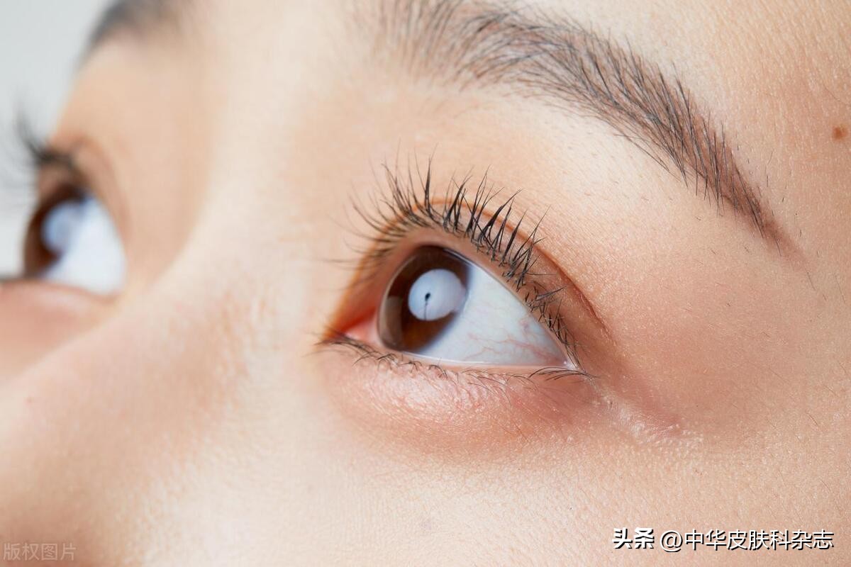 眼眶边上有很多小凸起,眼眶周围脂肪粒怎样清除