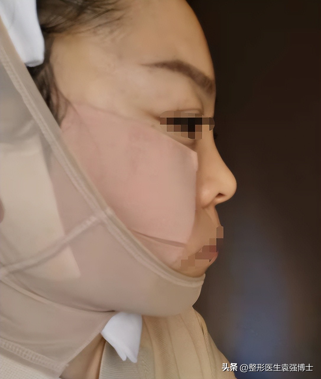 做拉皮恢复期太难熬,拉皮手术的十大问题