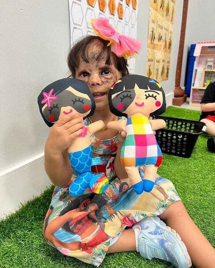 美国小女孩脸带“蝙蝠侠”黑印,治疗两年经过终于恢复肉色!