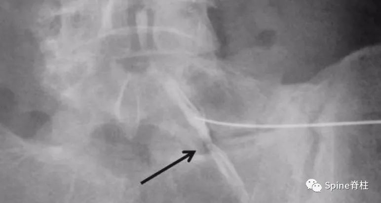 腰椎间盘突出症的治疗方法,腰椎间盘突出症状主要有哪些