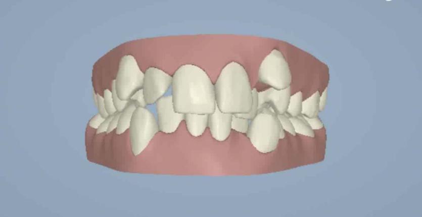 牙缝中的牙结石怎么去除,牙缝间的牙结石怎么清除