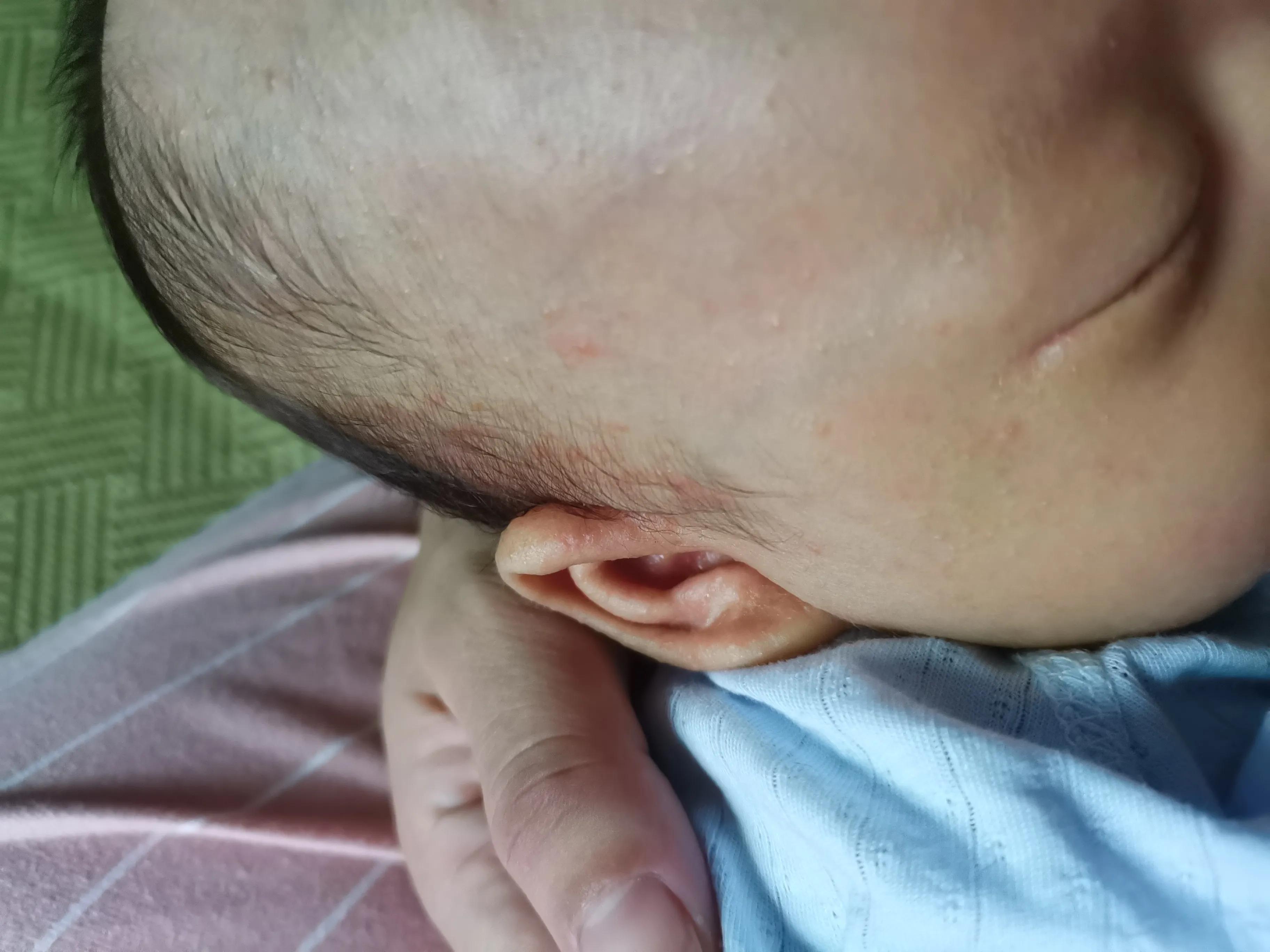 南方孩子长湿疹,南方的婴儿容易出湿疹吗