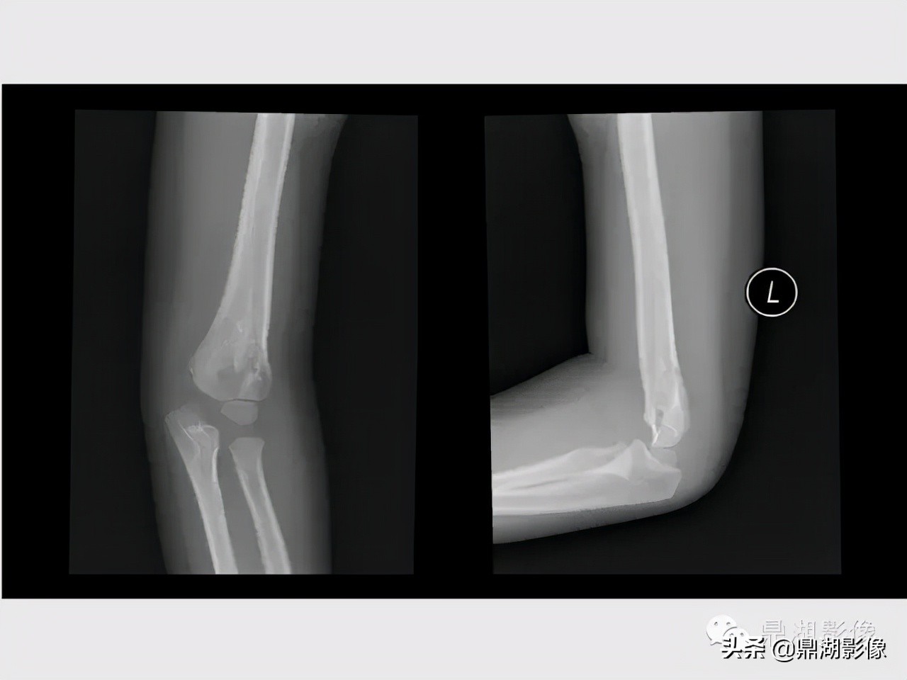 先天桡骨缺失畸形能治疗吗,先天性桡骨发育不良