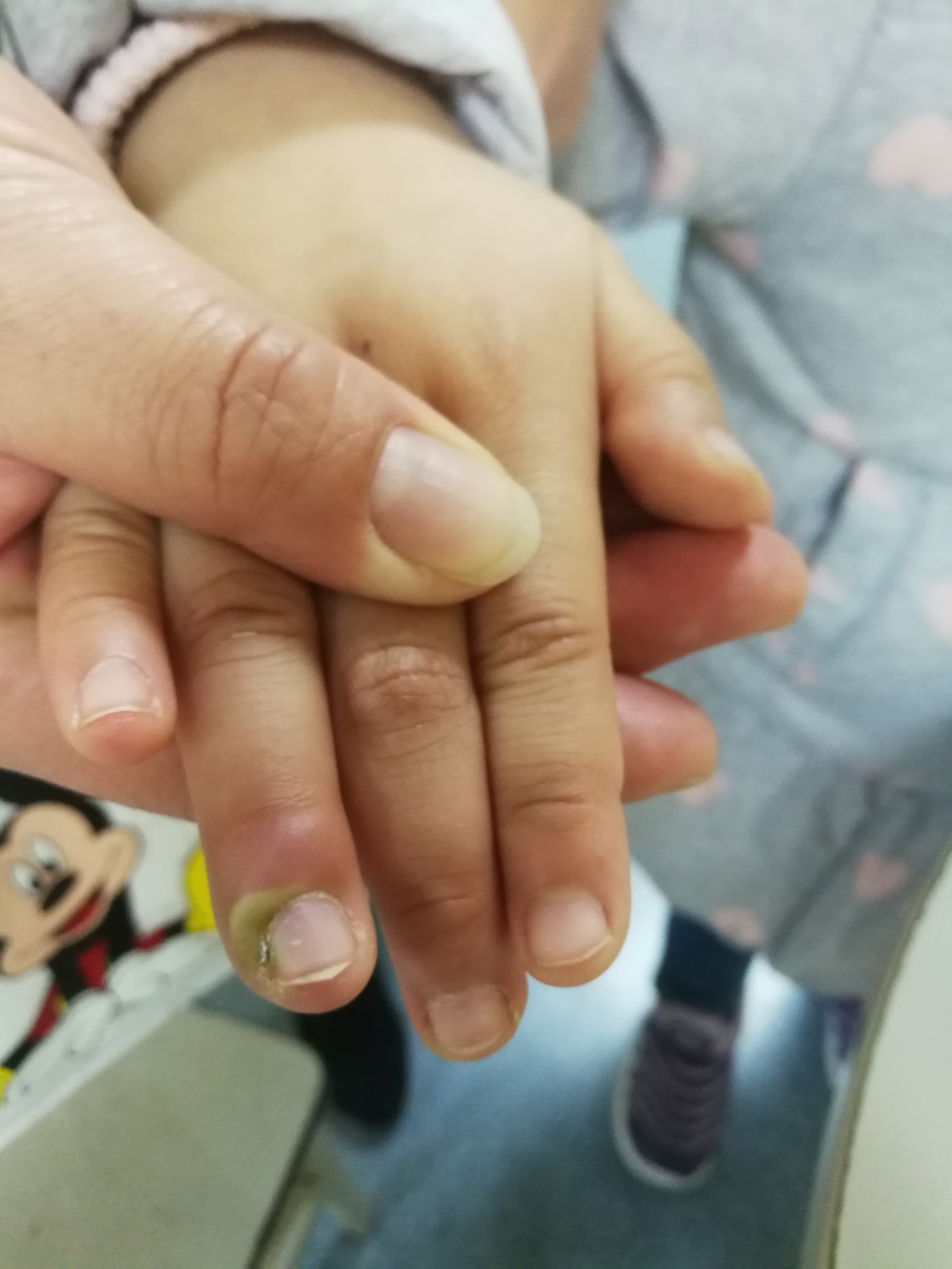 宝宝手指肿胀疼痛是怎么回事,小孩指头红肿疼痛是怎么了