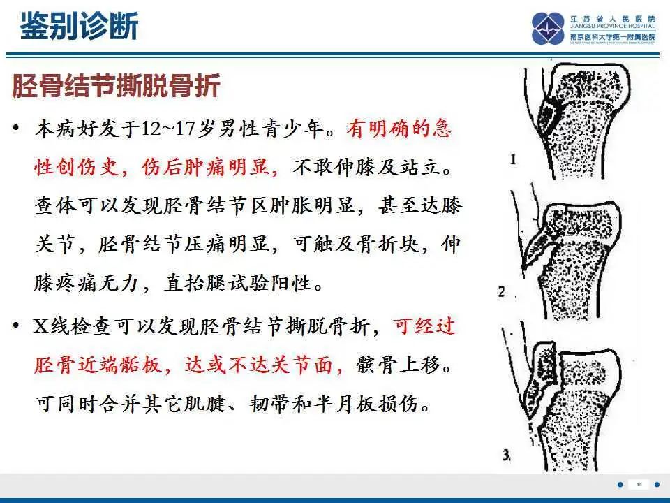 胫骨结节软骨炎要怎么治疗,胫骨结节骨软骨炎会癌变吗