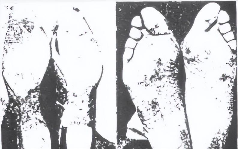 康复有问必答：扁平足怎么办？有没有改善的方法？