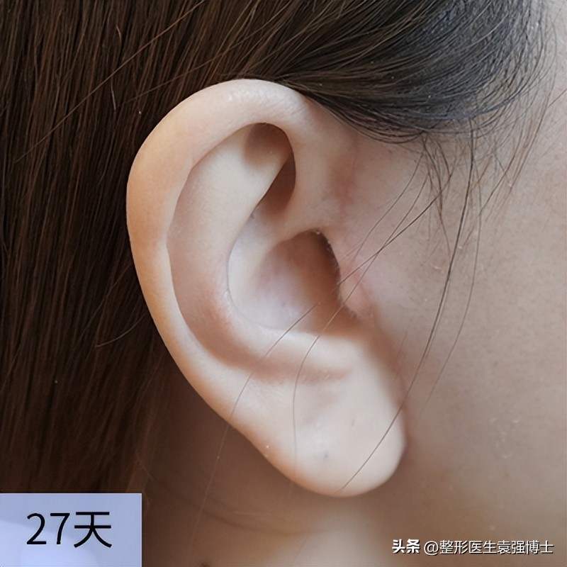 拉皮术后1-7天照片,科普一波大拉皮手术恢复期多少天