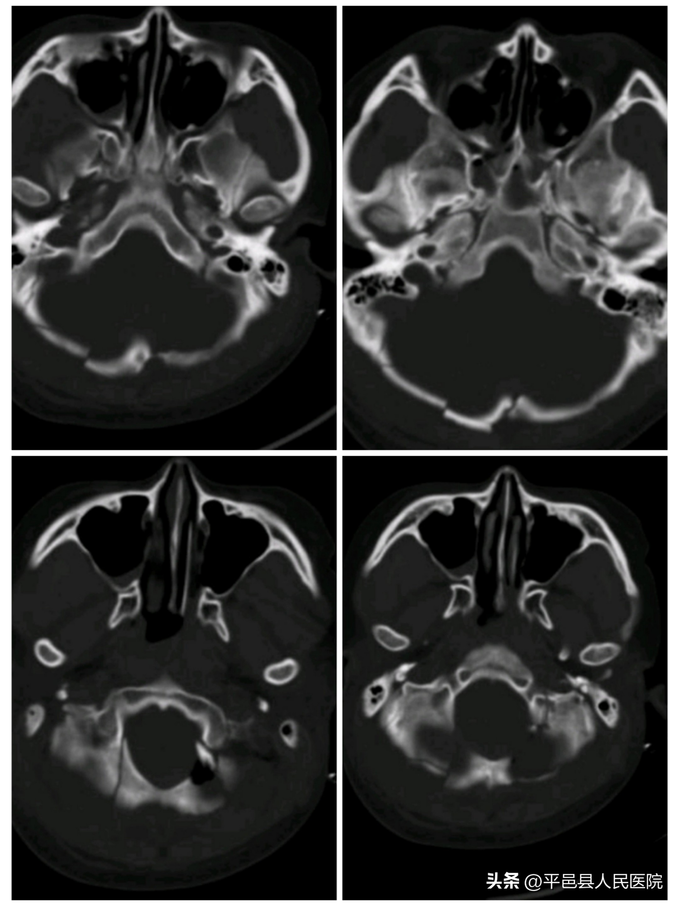 双十年华突发严重多发外伤多科协作联合手术成功救治