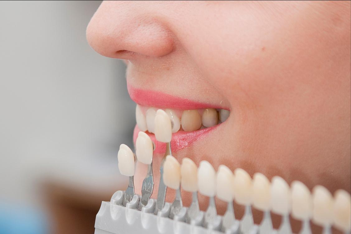 牙齿贴面的材料和品牌区别,牙贴面品牌十大排名最新