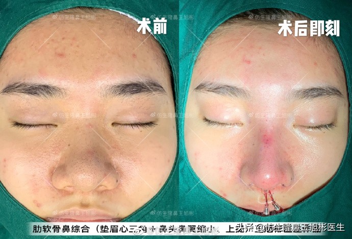 常见鼻部整形美容项目,整形鼻和自然鼻