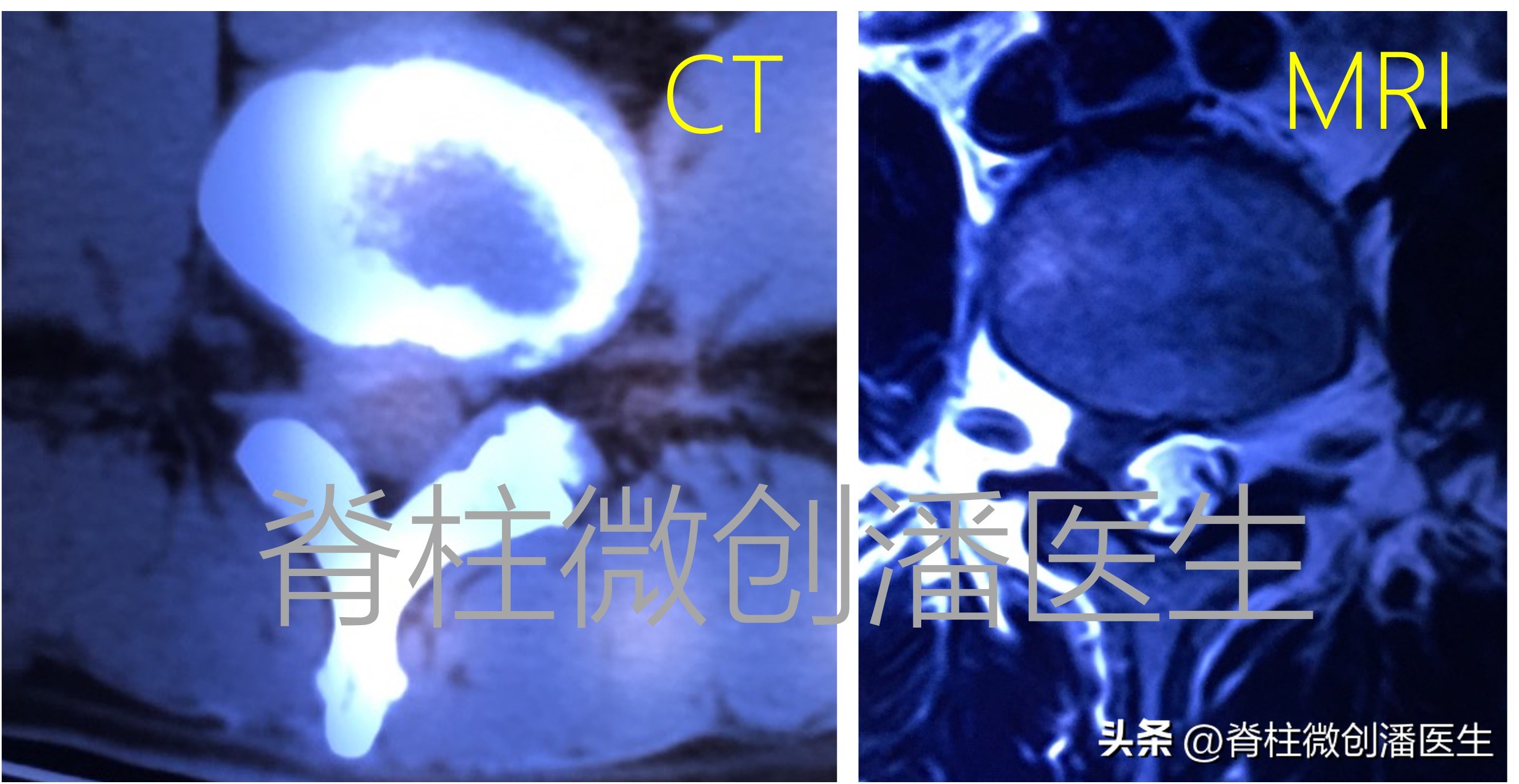 颈椎腰椎突出做ct还是核磁共振好,腰间盘突出确诊是拍x光还是ct