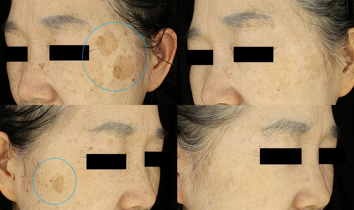 外泌体干细胞美容多长时间见效果,干细胞治疗老年斑多久能痊愈