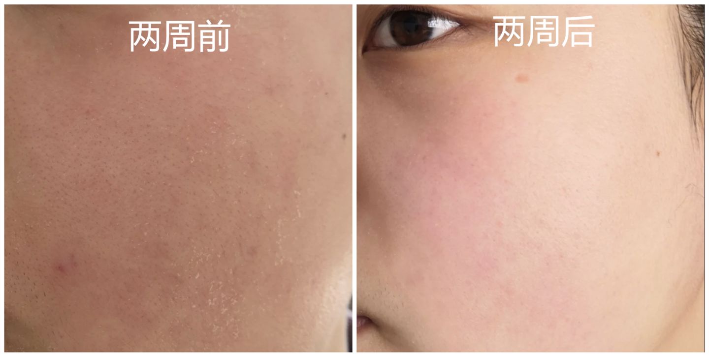 身上老是洗不干净是怎么回事,洗完澡皮肤干痒起白皮屑怎么回事