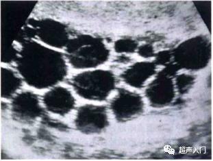 肝包虫病B超能检查出来吗?