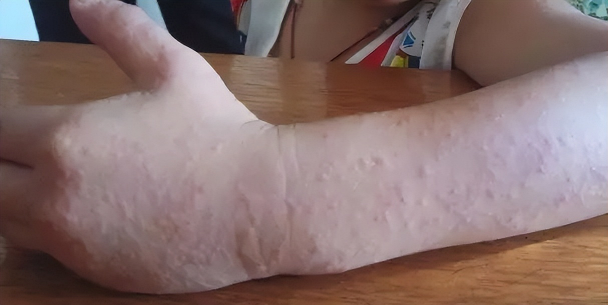 鲭鱼是发物吗能吃吗,鲭鱼有什么危害