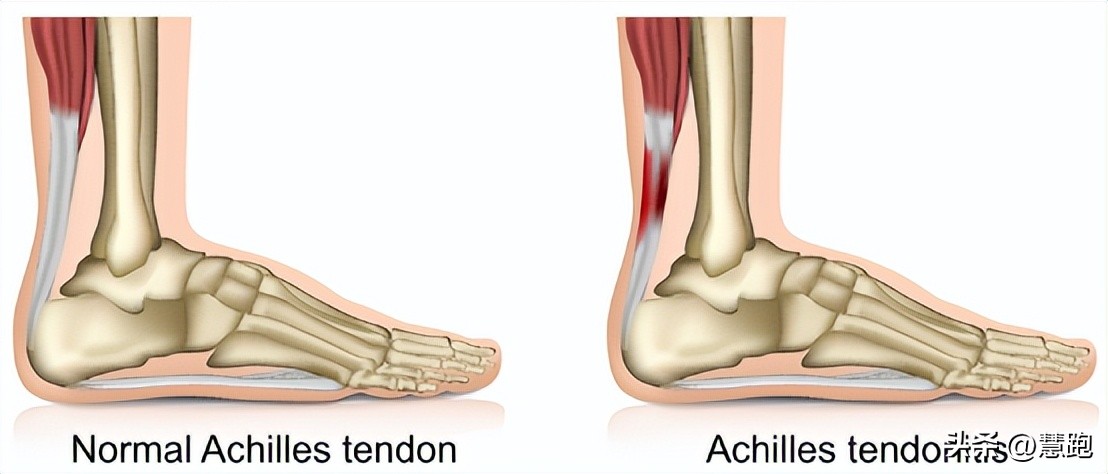 这类顽固性的跑步伤痛最让跑者头疼：4种有效康复方法教你破解