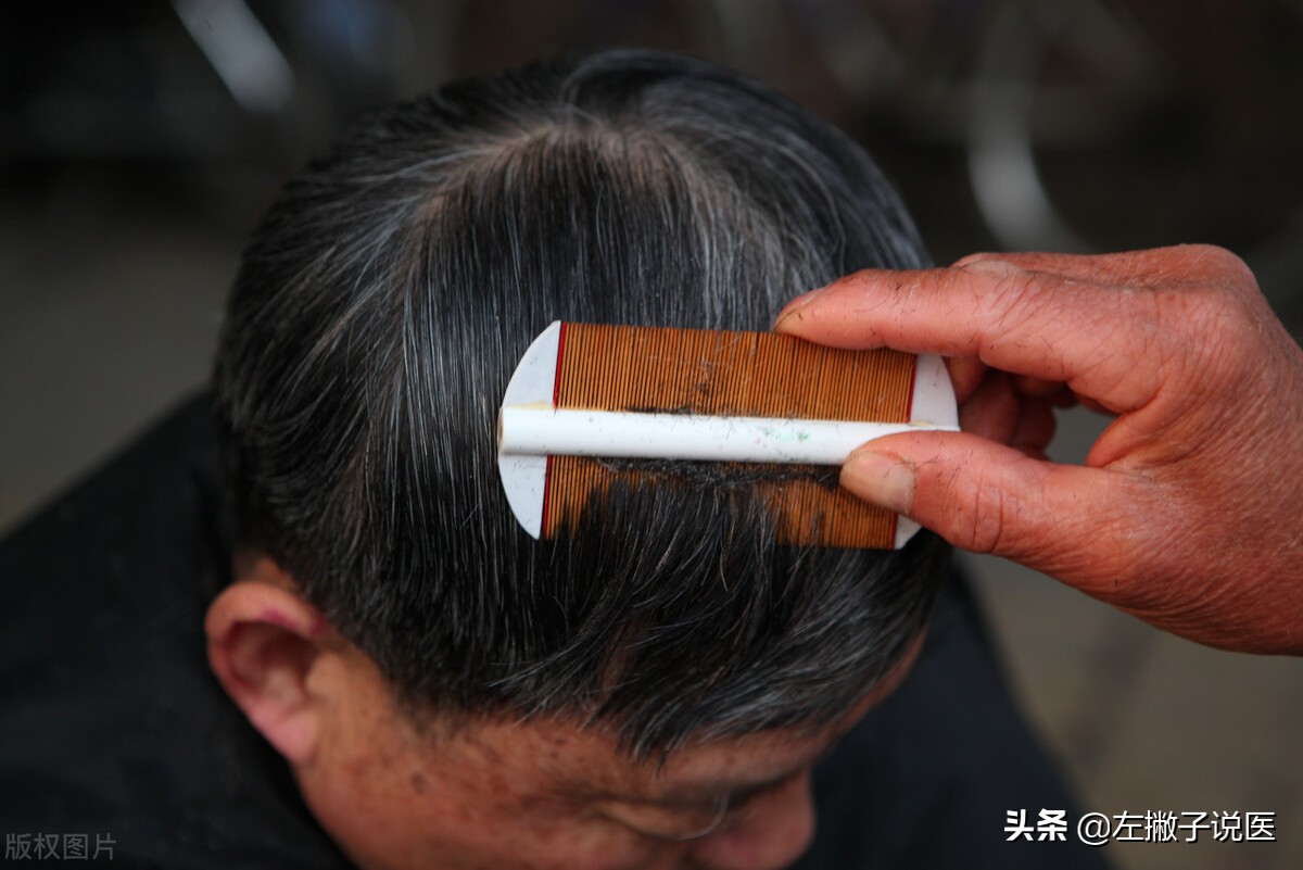 以前头上的虱子为什么现在也有呢,30年前人人身上都有的虱子
