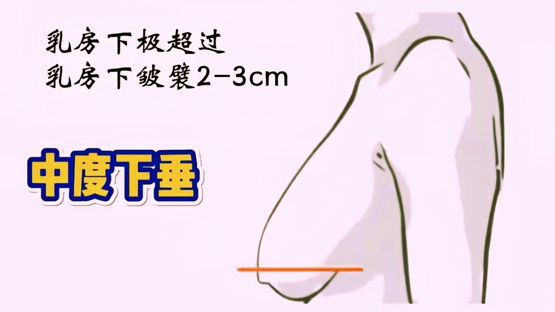 女人胸部下垂大小不一是什么问题,23岁胸部有一点下垂应该怎么办