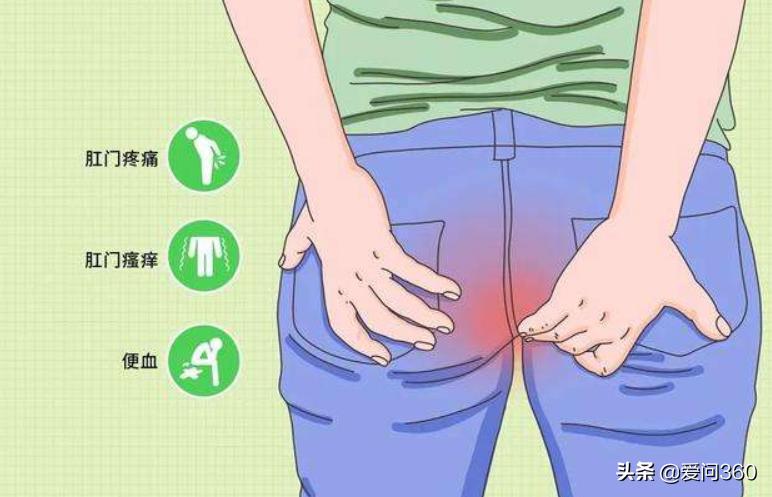 痔疮的预防方法主要是什么,关于痔疮的9个防治常识