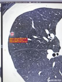“就信戴主任，火速做完手术”，肺磨玻璃结节妹子术后还愿贴