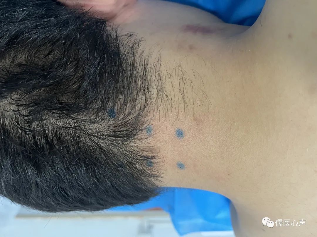 女童大拇指不能伸直,女宝三岁大拇指伸不直用做手术吗