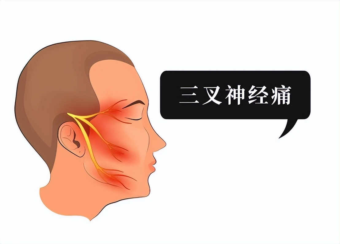 三叉神经痛伽玛刀可以维持多久,三叉神经痛伽玛刀有哪些副作用