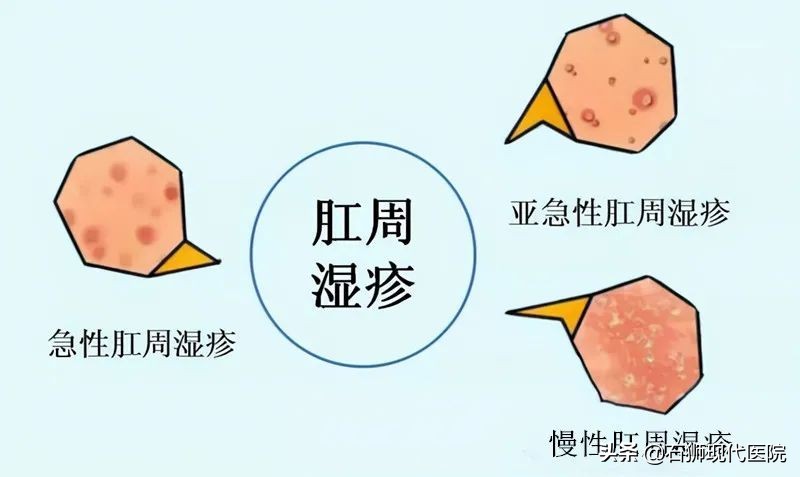 肛周湿疹瘙痒怎么治彻底,肛周湿疹痒得特别厉害怎么办