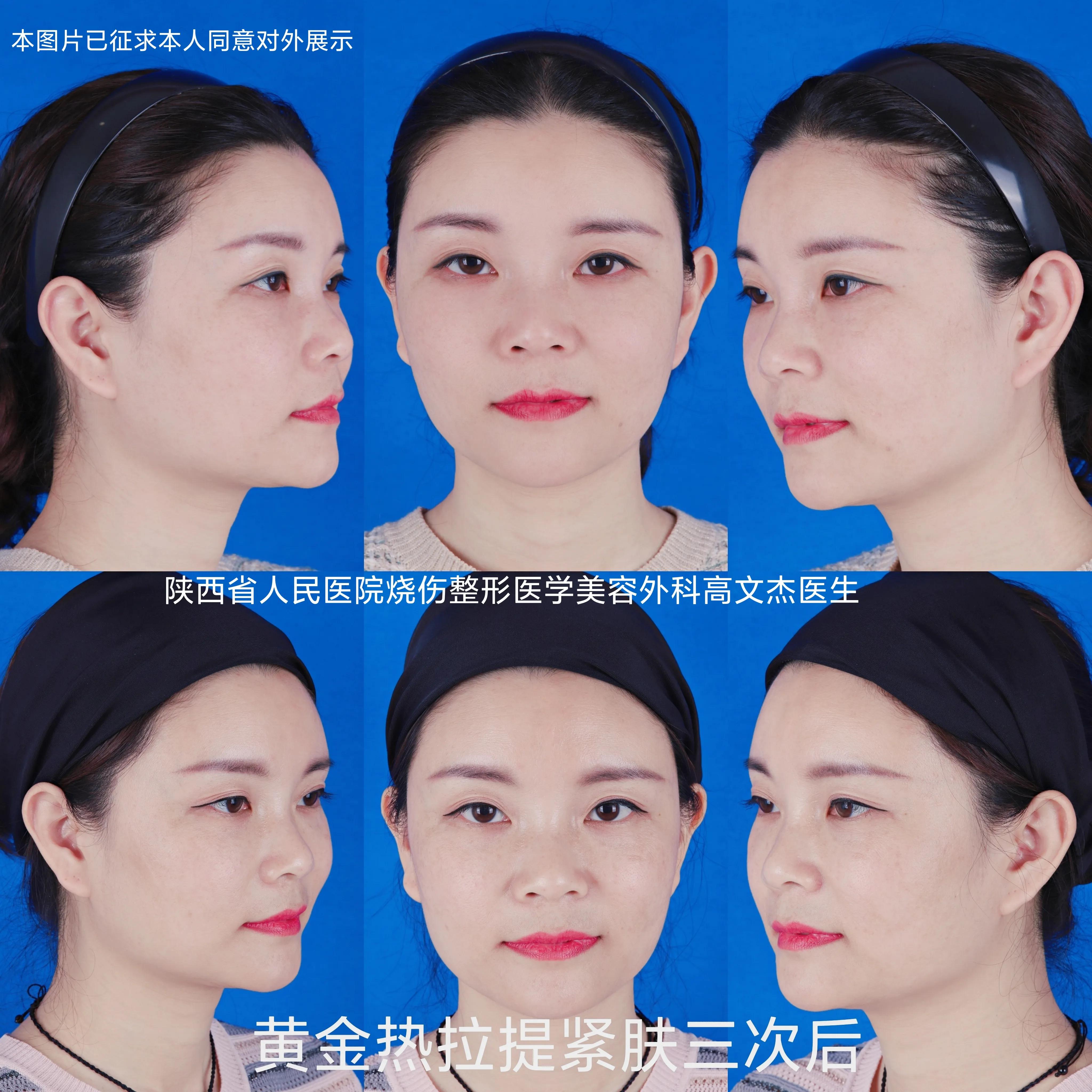 一句话帮你总结哪些医美项目,减龄的医美项目有哪些