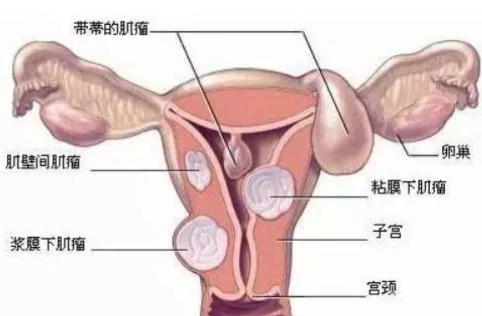 女人没有子宫和正常人有什么区别,没有子宫的女性对身体有什么影响