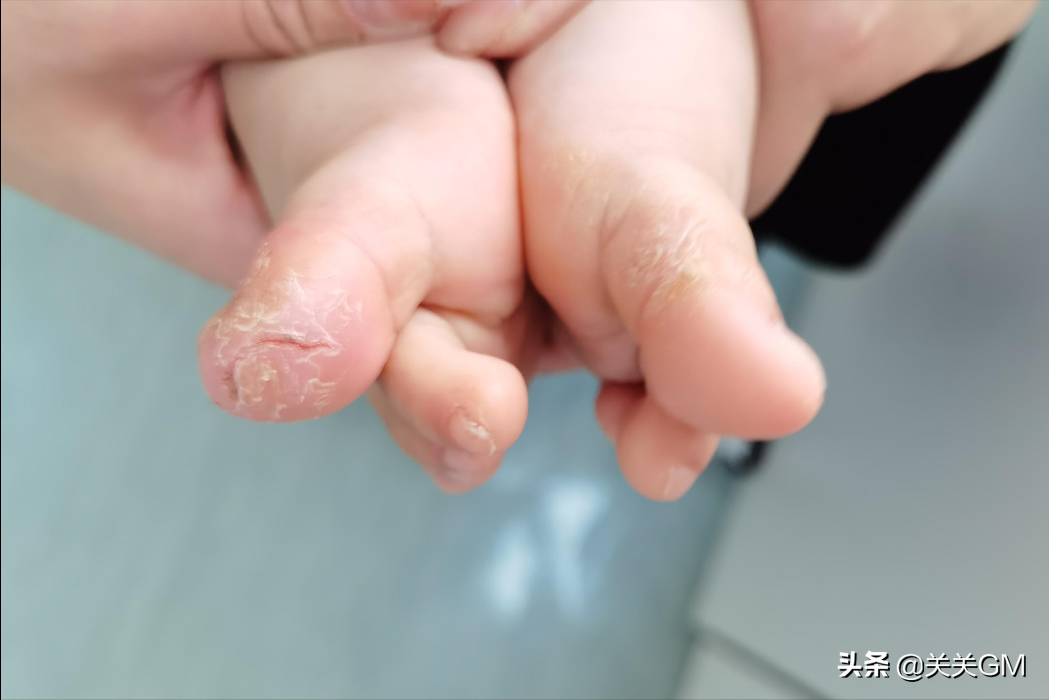 婴儿湿疹怎样尽早脱敏,儿童脱敏治疗有没有必要做