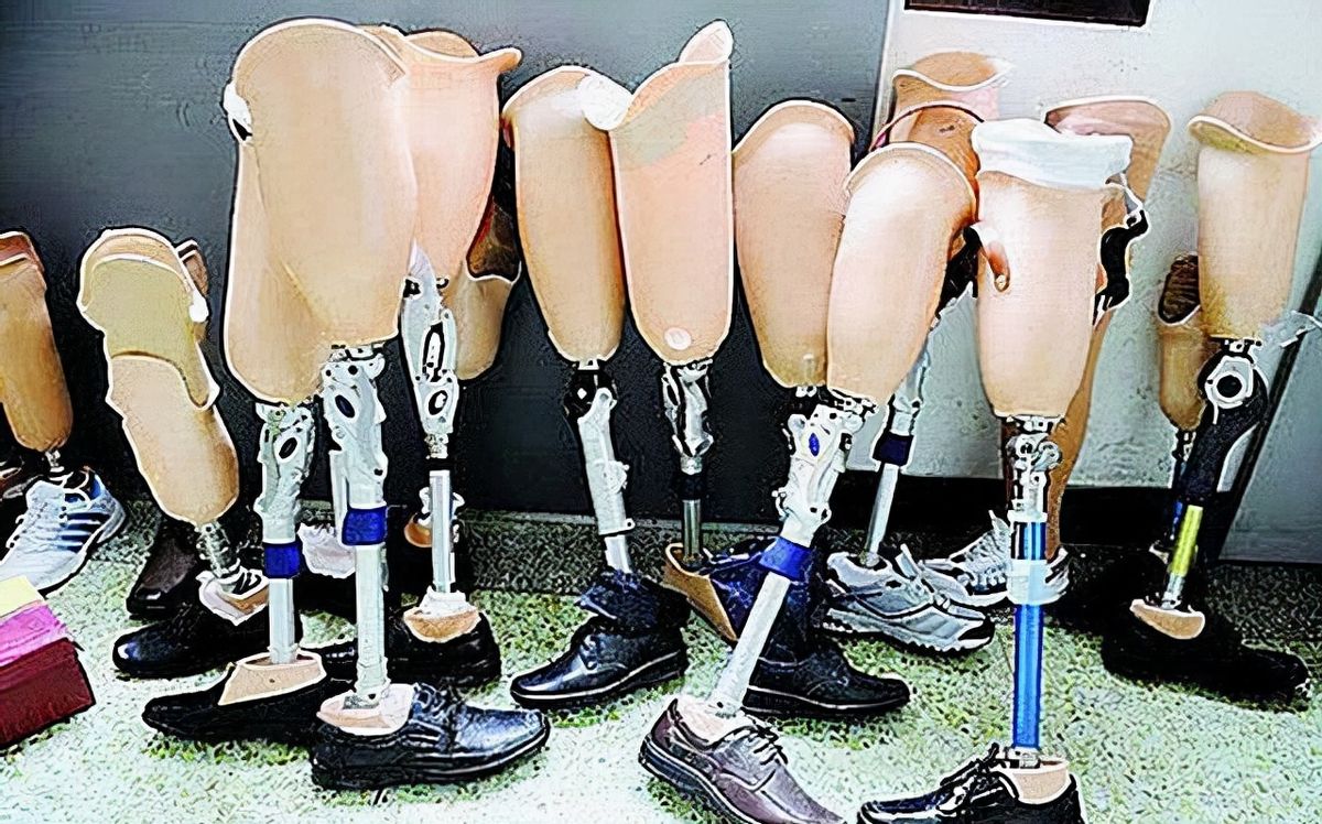 小腿巨粗的女孩,河南女子患病腿粗如大象