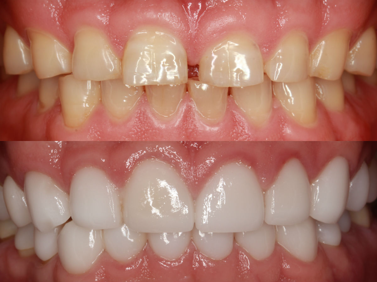 树脂补牙缝和贴面哪个好,牙缝大正畸还是贴面