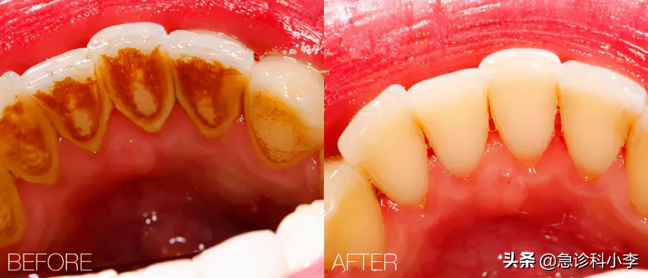 在牙缝里的牙结石要怎么去除,牙缝的牙结石怎么自己去除