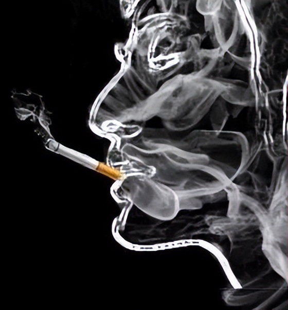 检查烟雾病脑子里有异常信号,左侧大脑烟雾病