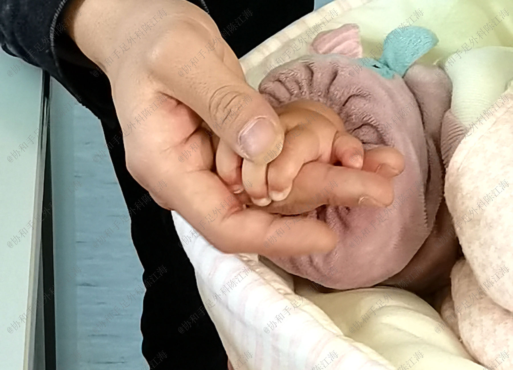 宝宝漂浮拇，被建议“一刀切”做示指拇化，我该怎么办？