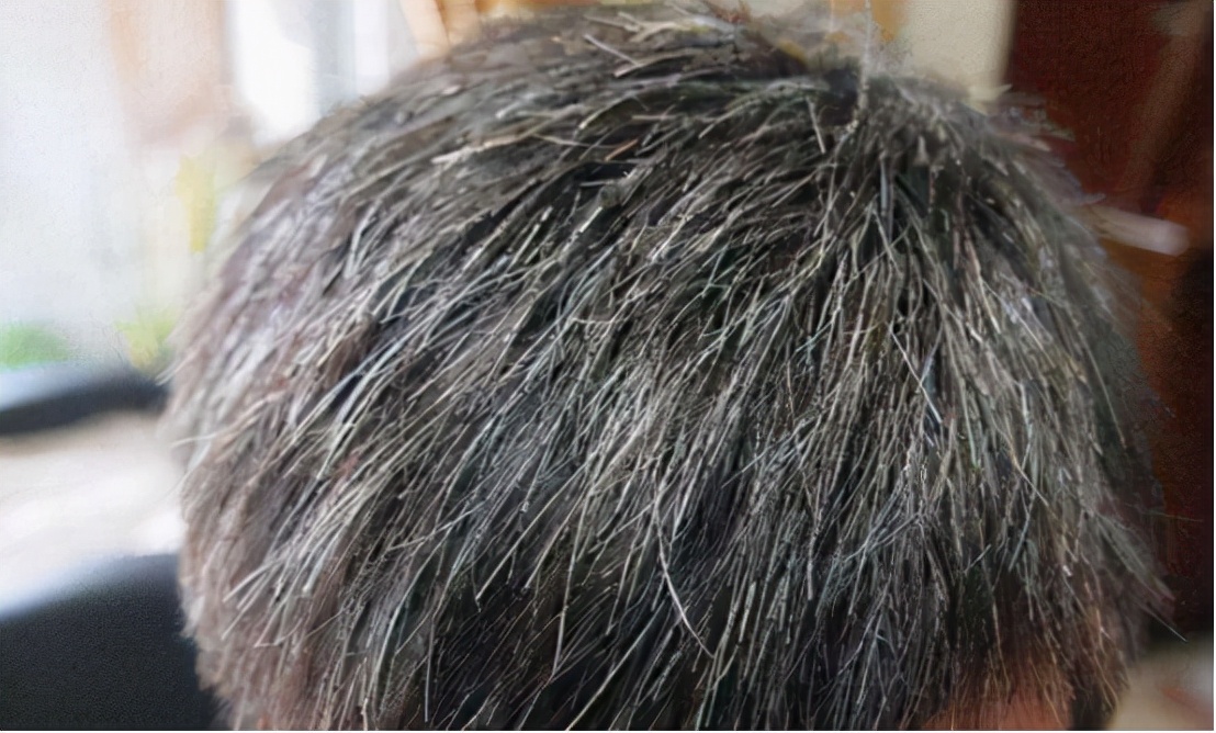 头发经常白发是因为什么,头发频繁出现白发怎么回事