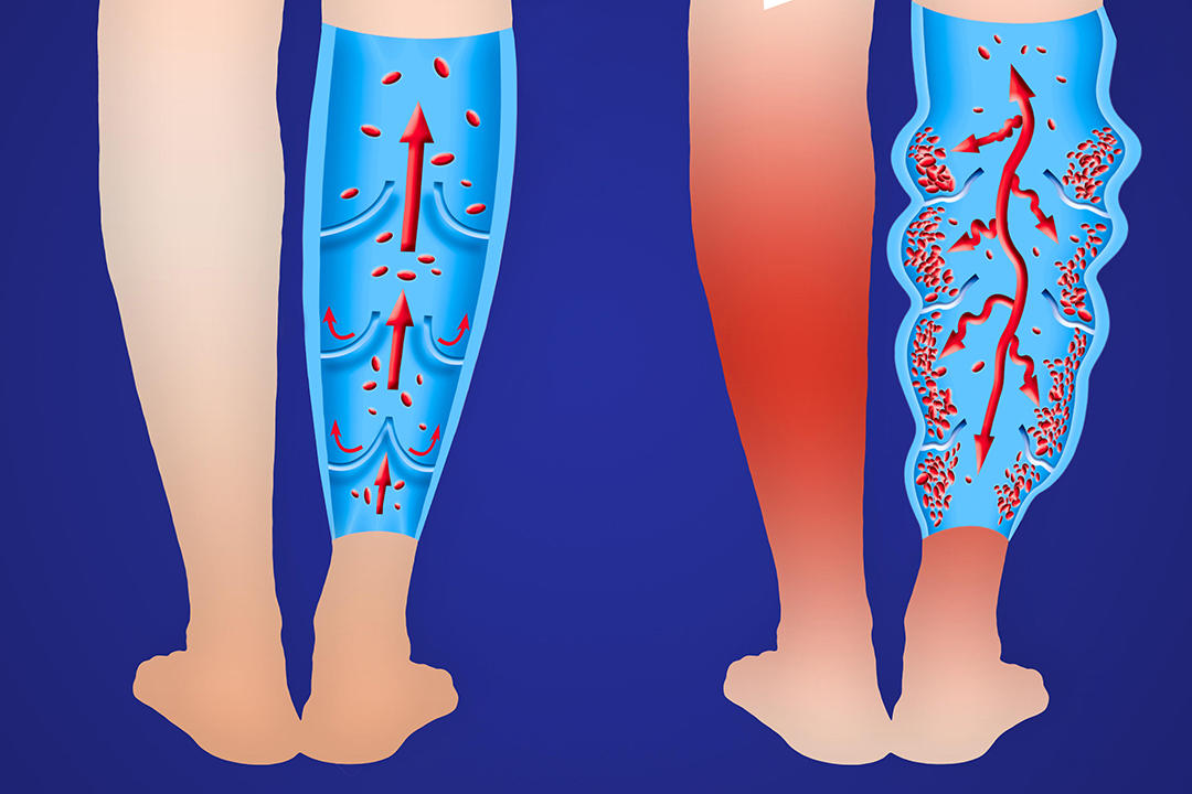 静脉曲张是打针治疗好，还是手术治疗好？其中的利弊要知道