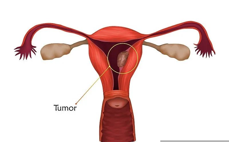 绝经后出血良性跟恶性的区别,绝经后异常出血