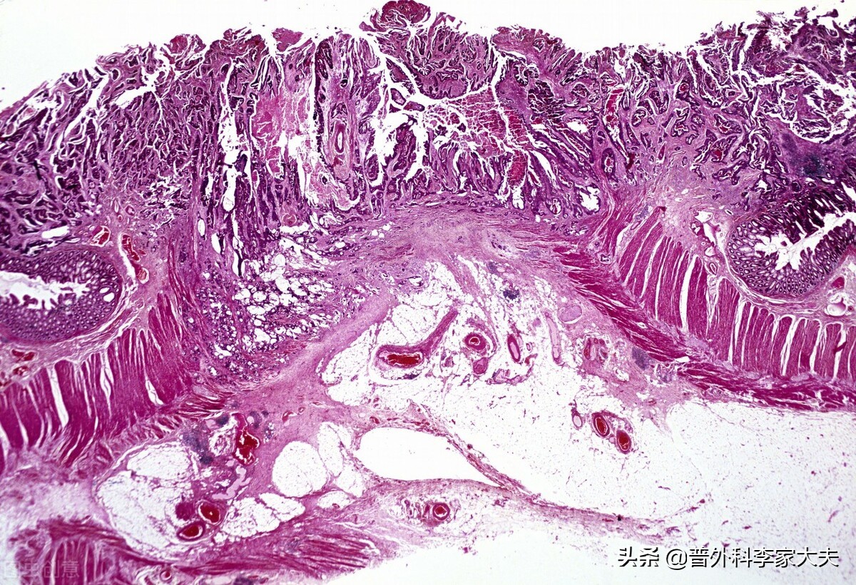 麦先生，我要对你说声抱歉，肠癌手术后让你辛苦了