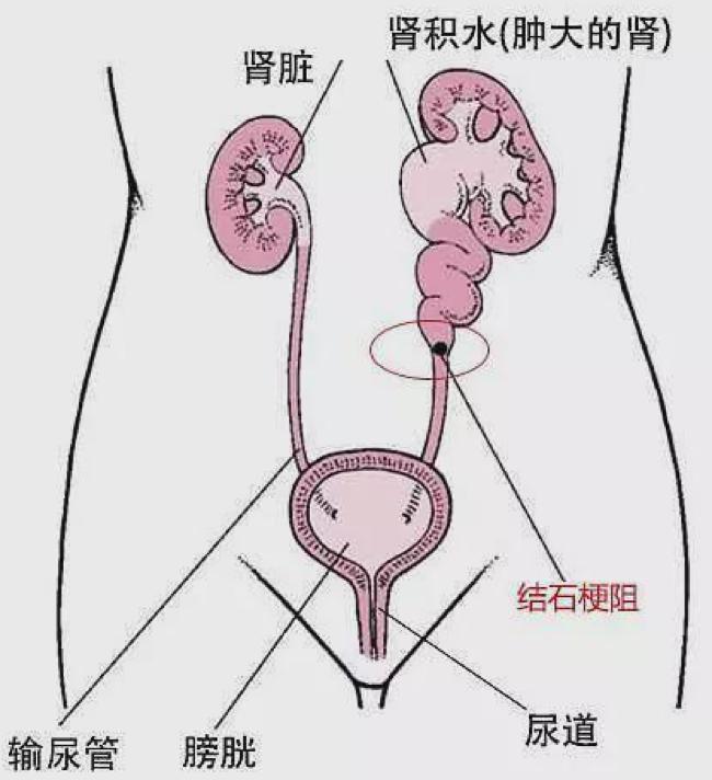 排尿困难？有可能是输尿管梗阻！