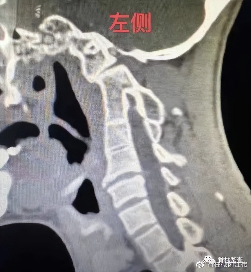 颅底凹陷症齿状突半脱位,颅底手术新突破