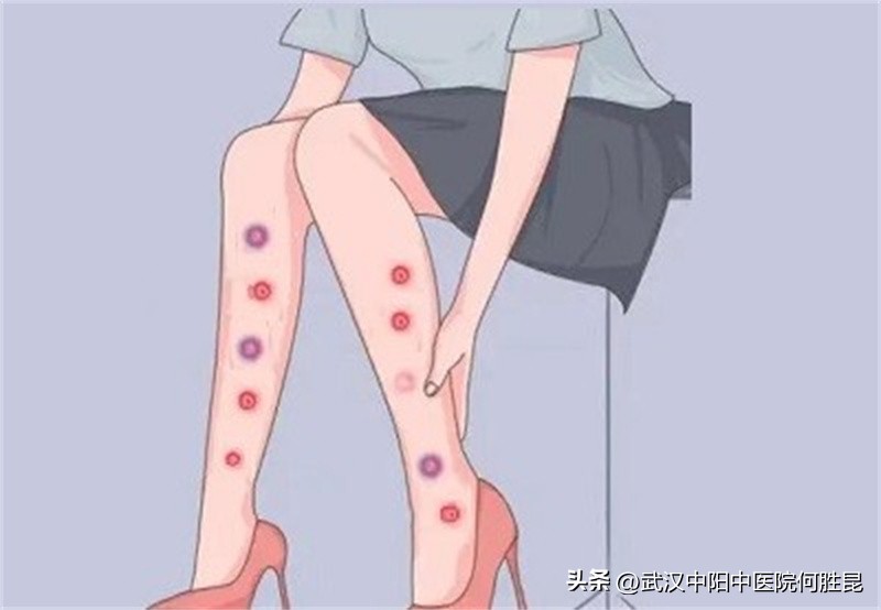 腿上长红疙瘩很痒像蚊子包,脚上腿上长红色疙瘩很痒怎么办