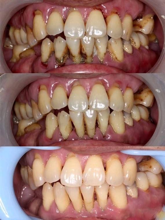 什么是牙周炎有什么危害,牙周病的原因和危害