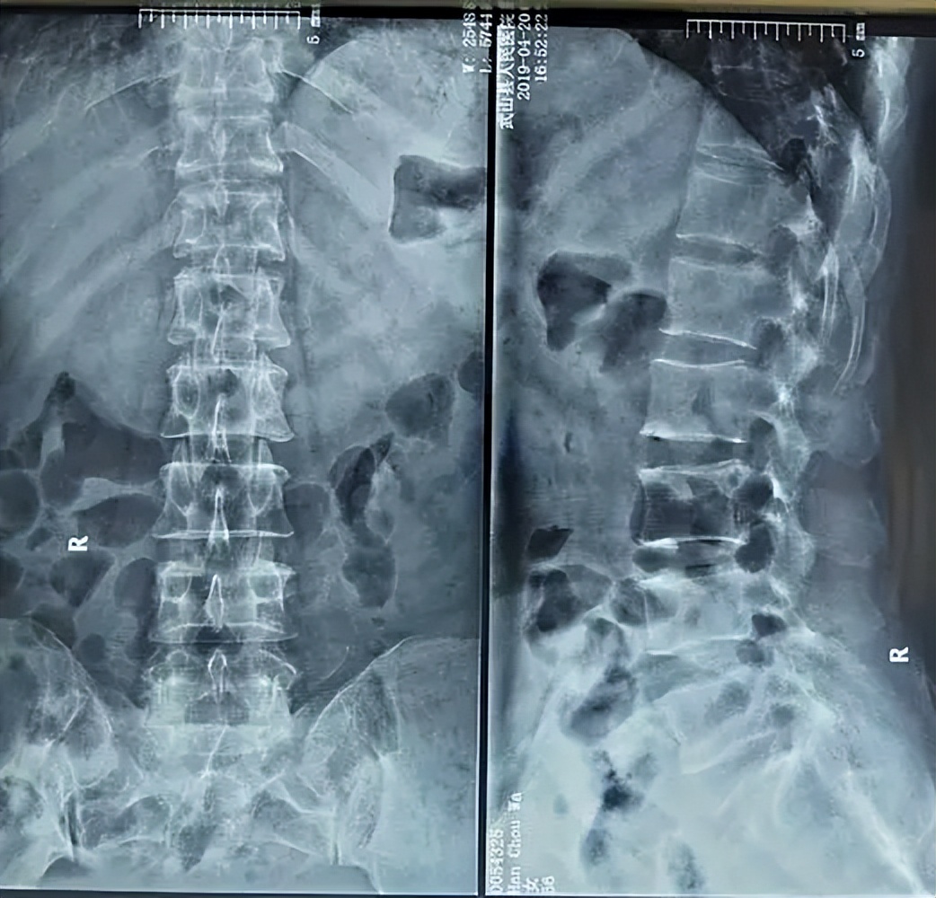 50岁老板走路突发腿痛,疑似腰椎盘突出,医生:血管堵塞需要截肢