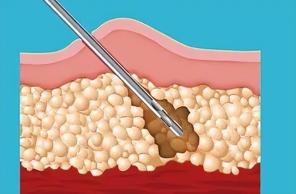 九院韦敏教授,九院韦敏教授聊整形