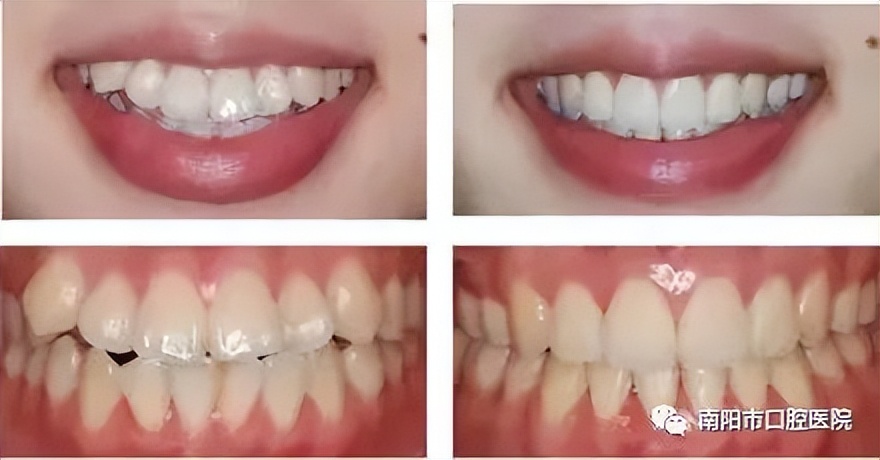 让你的牙齿变美,让牙齿变美的小技巧