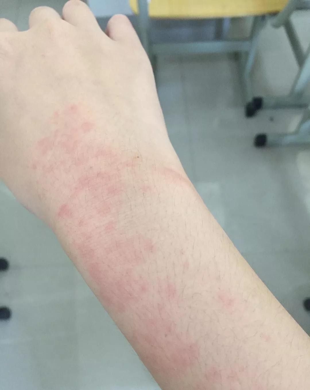 当归六黄汤治疗手汗症,血燥皮肤痒中药方子大全