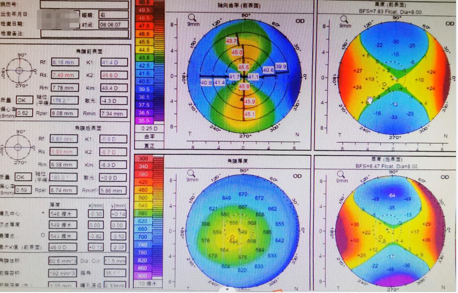 南阳市南石眼科全飞秒激光多少钱,南阳南石医院飞秒价格