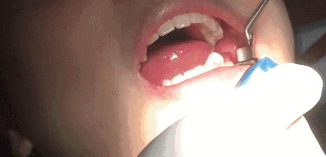 三岁孩子一口牙全坏了,孩子一口牙齿烂光了